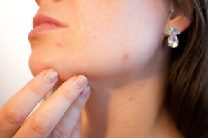 黒ずみと臭いを解消する保湿重視のクリームはどれが効果的？